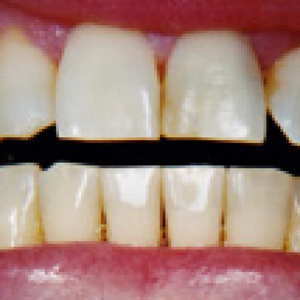 34791 brushing technique