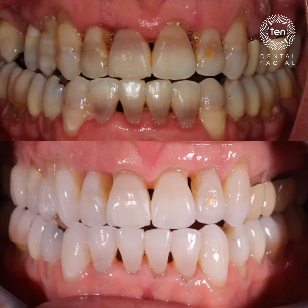 34791 fluoride treatment