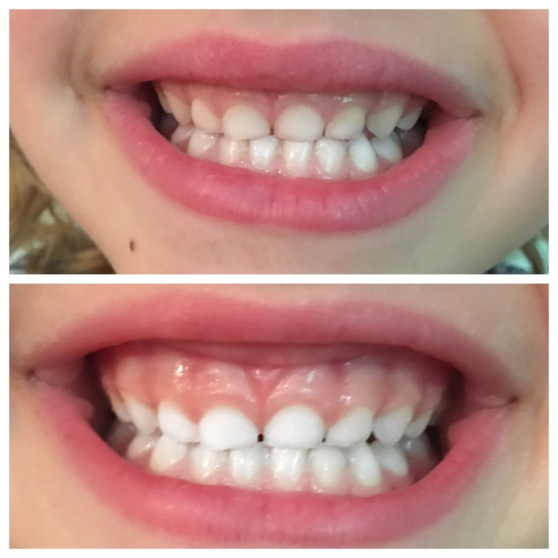 34798 kids teeth sensitivity