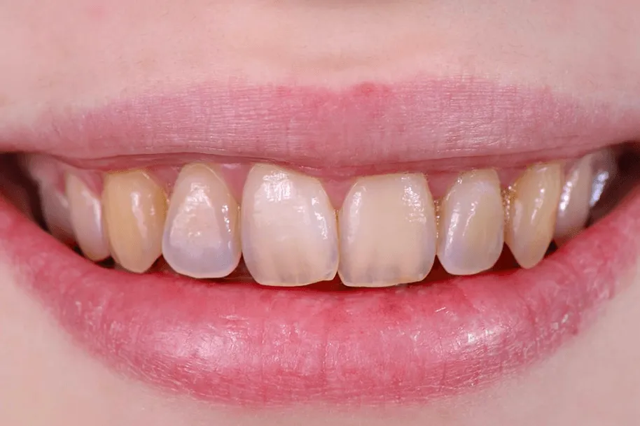 /img/34800-gum-recession.webp