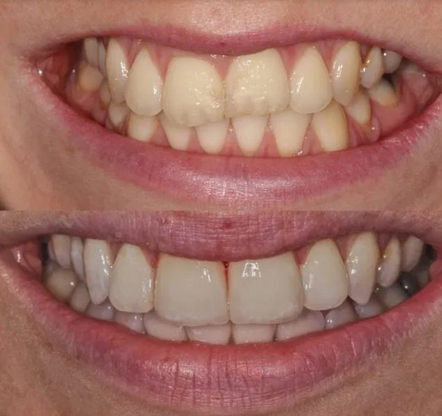 34800 professional whitening