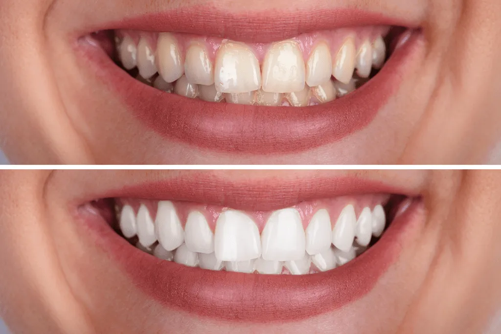 34804 teeth whitening spring tx confidence
