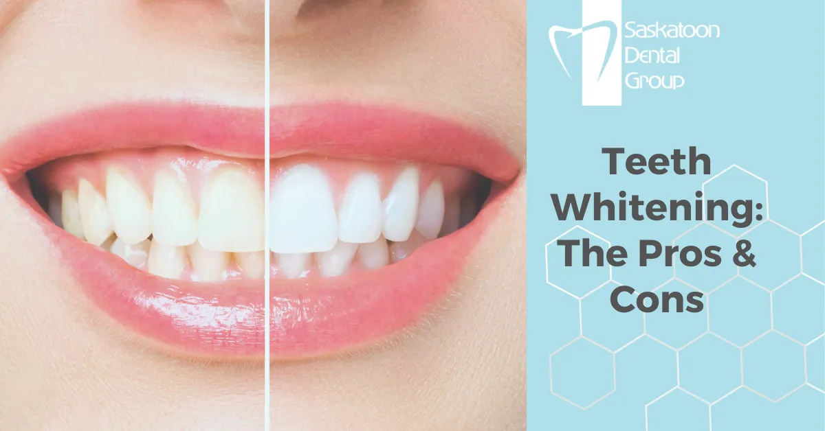 34805 at home teeth whitening