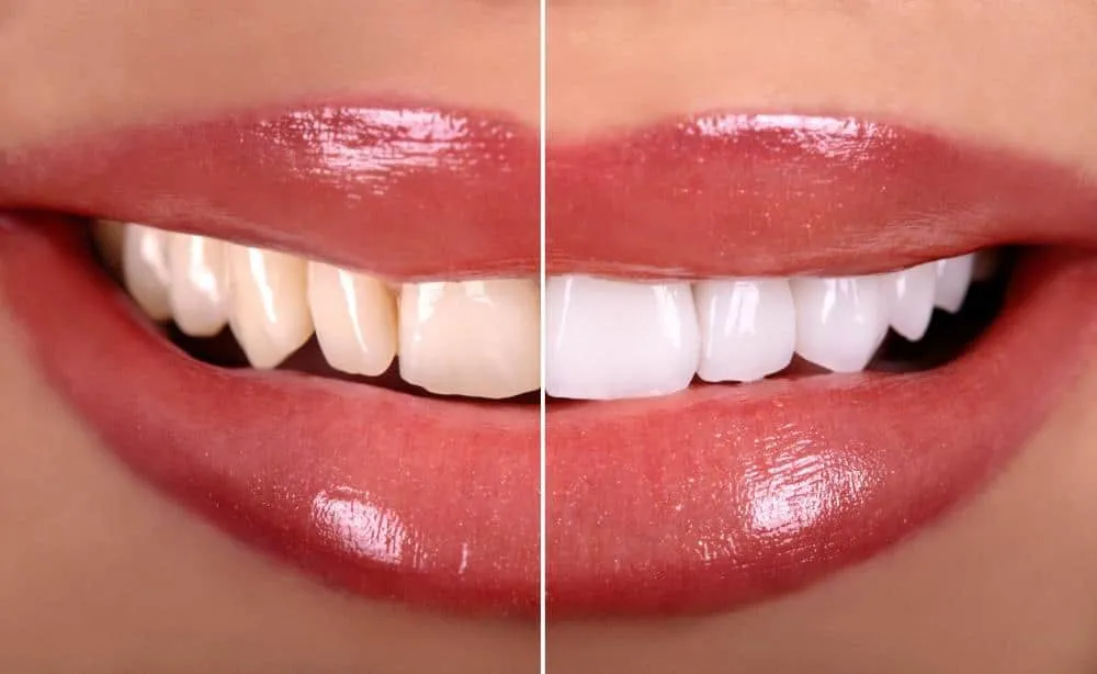 34813 gentle brushing technique