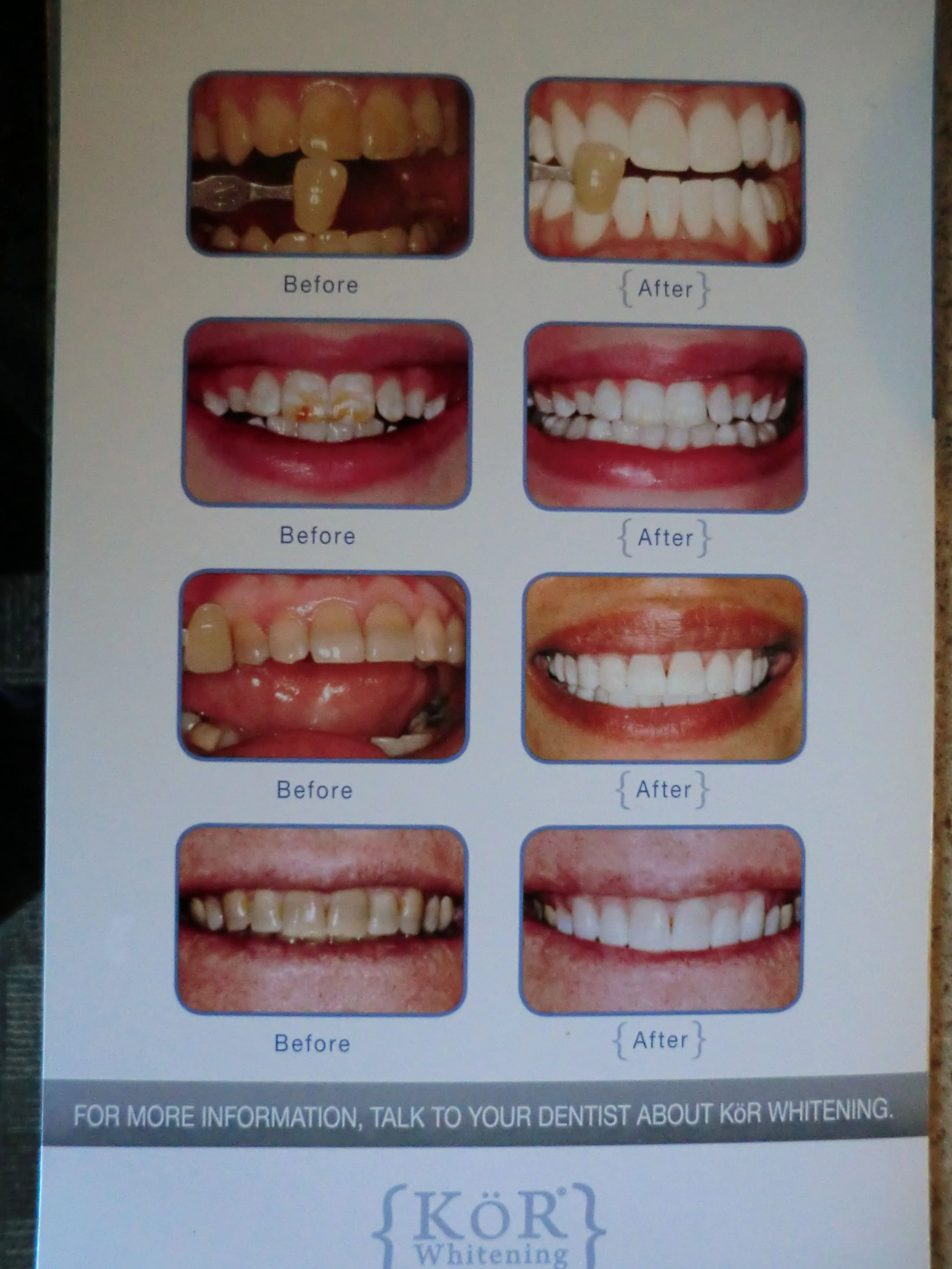 /img/34815-maintaining-teeth-whitening.webp