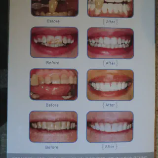/img/34815-maintaining-teeth-whitening.webp